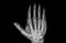 X-ray image of left hand show fracture at little finger phalanxes