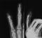 X-ray image of little finger fracture.