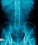 X-ray image lumbar