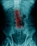 X-ray image lumbar spine