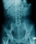 X-ray image lumbar spine and degenerative change of spine