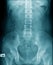 X-ray image lumbar spine and degenerative change of spine