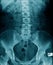 X-ray image lumbar spine and degenerative change of spine