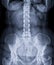 X-ray image of lumbar Spine  or L-s spine front view for diagnosis lower back pain