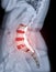 X-ray image of lumbar Spine  or L-s spine lateral view with MRI  l-s spine  for diagnosis lower back pain