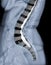 X-ray image of lumbar Spine  or L-s spine lateral view with MRI  l-s spine  for diagnosis lower back pain