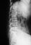 X-ray image of lumbar spine(L-spine), lateral view. showing com