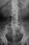 .X-ray image of Lumbosacral (L-S) spine.