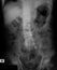 X-ray image of Lumbosacral (L-S) spine, AP view.