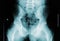 X-ray image of male pelvis, femoral neck and lumbar vertebrae. Medical and human anatomy imagery