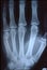 X-ray image, man, hand with bones