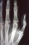 X-ray image, man, hand with bones