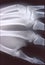 X-ray image, man, hand with bones