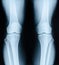 X-ray image patient with degenerative change of knee joint