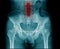 X-ray image of pelvic bone and part of lumbar spine