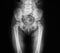 X-ray image of pelvic and hip, AP view.