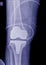 X-ray image post operation total knee replacement