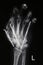 X-ray image of re-connected hand surgery