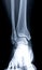 X-ray image of right ankle joint.