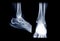 x-ray image of right ankle joint  AP and Lateral view.
