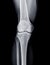 X-ray image of Right knee joint AP view.