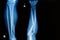 X-ray image show fracture leg and forearm