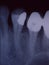 X-ray image of teeth with fillings