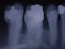 X-ray image of teeth with fillings