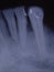 X-ray image of teeth with fillings