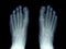 X-ray image of two feet