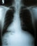 X-Ray image, View of chest men for medical diagnosis.