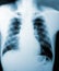 X-Ray image, View of chest men for medical diagnosis.