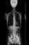 X-ray image of Whole  Spine  for diagnosis scoliosis of spine