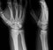 X-ray image of wrist joint, AP and Lateral view.