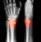 X-ray image of wrist joint, AP and Lateral view.