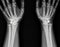 X-ray image of  wrist joint front view of normal wrist joint