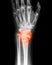 X-ray image of wrist joint , PA view.