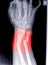 X-ray image of wrist joint, shows fracture of the distal radius and ulna on color mark