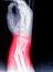 X-ray image of wrist joint, shows fracture of the distal radius and ulna on color mark