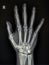 X-ray images showing the right hand bone.