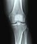 X-ray knee