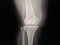 X-ray Knee ap normal radiography of the knee joint, medical diagnostics, traumatology and orthopedics