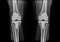 X-ray knee athoplasty