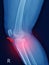 X-ray knee Fracture proximal metaphysis of tibia.Depressed fracture of lateral tibial plateau.severe swelling of soft tissue on