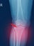 X-ray knee Fracture proximal metaphysis of tibia.Depressed fracture of lateral tibial plateau.severe swelling of soft tissue on