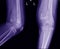 X-ray Knee join Showing large osteolytic lesuion of medial aspect of left distal femur.with soft tissure mass.and malignant bone t