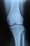 X-ray of knee joint