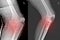 X-ray Knee Joint Fracture proximal tibia and Post fix fracture proximal tibia