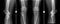 X-ray of knee joints. Giant cell tumor of the right tibial.