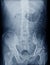 X-ray L-S spine AP. views showing Compression fracture L1 vertebral body. Medical image concept